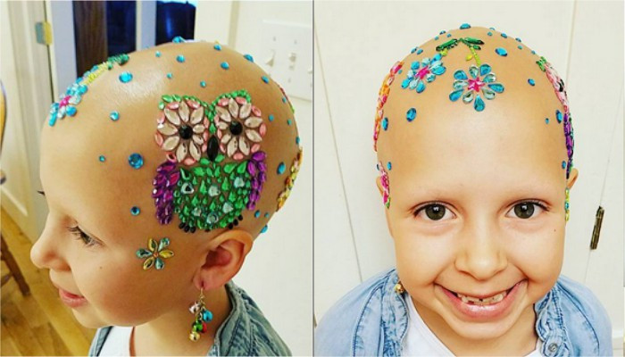 Children With Alopecia Day